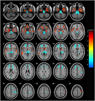 Severity related neuroanatomical and spontaneous functional activity alteration in adolescents with major depressive disorder